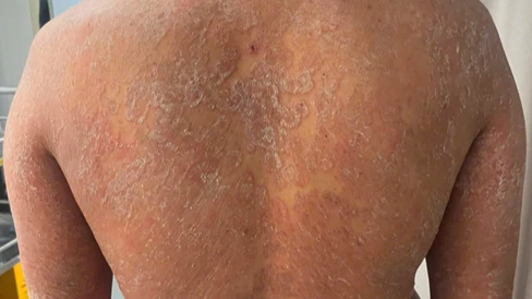 Cảnh báo: Tự điều trị nấm da sai cách gây hậu quả nghiêm trọng