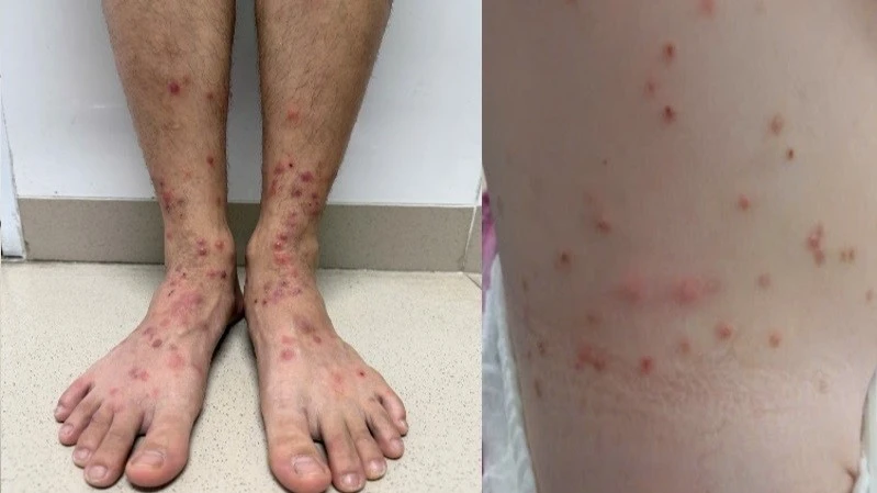 Cảnh báo bọ chét tấn công: Nhiều bệnh nhân ngứa dữ dội, tự điều trị sai cách