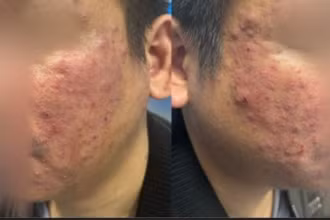 Viêm da mặt kéo dài, người bệnh bất ngờ phát hiện nhiễm ký sinh trùng Demodex