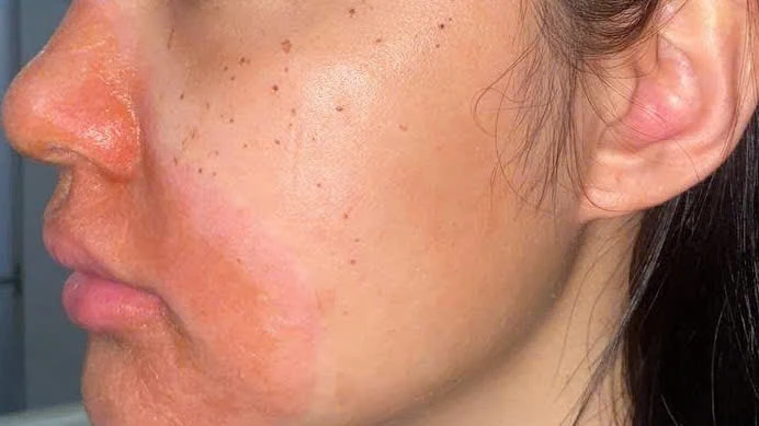 Cảnh báo nguy hiểm từ peel da tại spa không uy tín