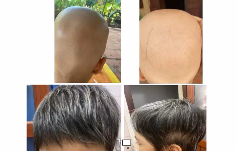 Hình ảnh da đầu cháu bé trước và sau khi điều trị.