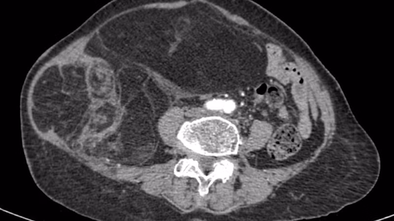 Hình ảnh phim chụp CT ổ bụng của người bệnh.