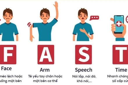 Nguyên tắc FAST của ngành y trong ứng cứu đột quỵ. 