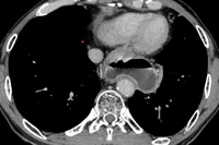 Hình ảnh tổn thương ống dạ dày trên chụp cắt lớp vi tính. (Ảnh: BVCC)
