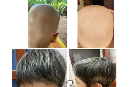 Hình ảnh da đầu cháu bé trước và sau khi điều trị.