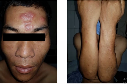 Tổn thương mảng đỏ vùng trán, sẩn đỏ 1 – 2cm rải rác vùng mặt, tay. Mặt mu bàn tay khô, mất bóng. (Ảnh: BVCC)