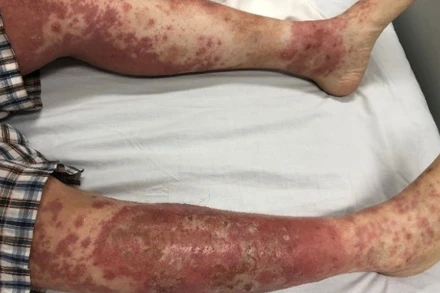 Tổn thương của bệnh nhân do tự ý điều trị bệnh vảy nến.