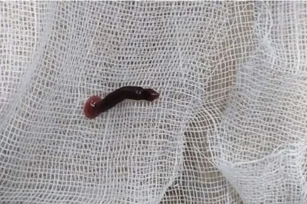 Con đỉa được gắp ra từ mũi em P.