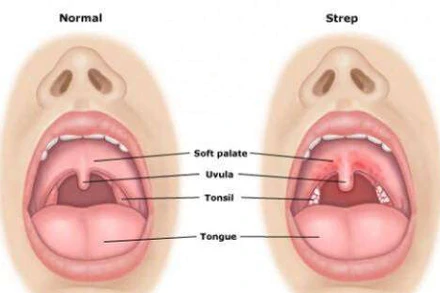 Bệnh bạch hầu gây ra những biến chứng nguy hiểm nào?