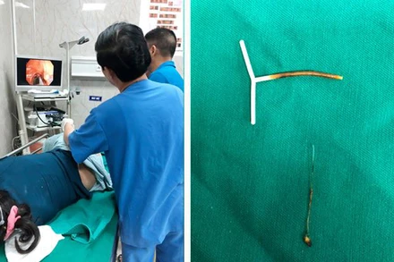 Kíp bác sĩ Khoa Nội soi tiêu hóa thực hiện gắp dị vật cho bệnh nhân N.