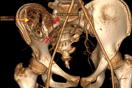 Hình ảnh khối u khổng lồ và hệ thống phức tạp mạch máu nuôi u.