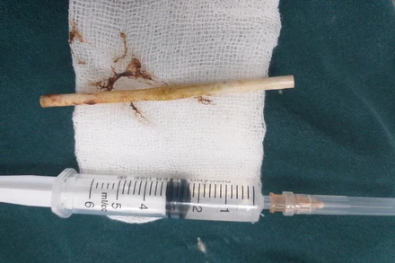 Dị vật được gắp ra trong ruột cháu bé là một que kẹo bằng nhựa dài 10 cm