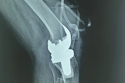 Bệnh nhân mắc lao khớp gối được thay khớp thành công. 