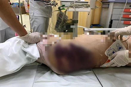 Bé A. tại bệnh viện sau khi bị bạo hành. (Ảnh: A.X.)