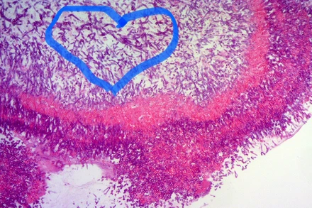 Hình ảnh nấm Aspegillus fumigatus trên tiêu bản nhuộm soi giải phẫu bệnh.