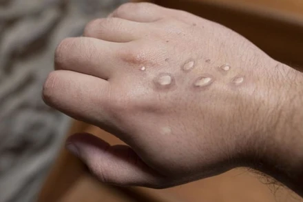 Một bệnh nhân mắc bệnh đậu mùa khỉ. (Ảnh: iStock)