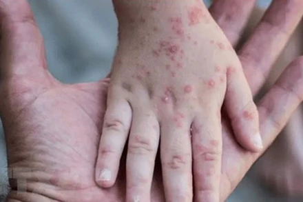 Một em nhỏ mắc bệnh đậu mùa khỉ tại Israel. (Ảnh: Reuters/TTXVN)