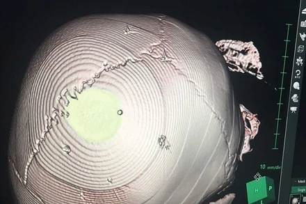 Hình ảnh chụp vết thương sọ não của bé 3 tuổi. (Ảnh: Bác sĩ bệnh viện Xanh Pôn cung cấp)