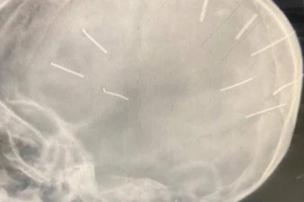 Hình ảnh phim chụp X-quang phát hiện trong hộp sọ cháu bé có nhiều dị vật giống đinh.