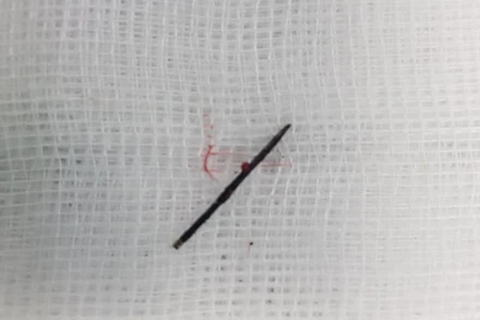 Chiếc kim khâu được lấy ra từ cơ thể bệnh nhi.