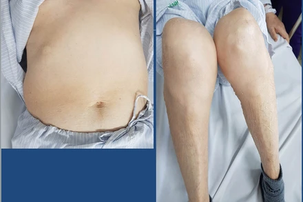 Bệnh nhân có biểu hiện kiểu hình Cushing.