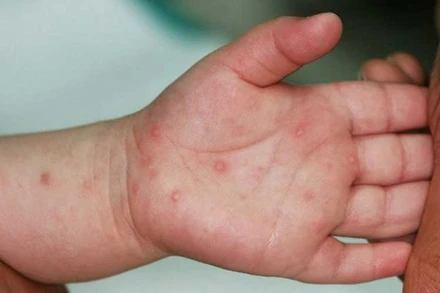 Không thiếu thuốc điều trị bệnh tay chân miệng