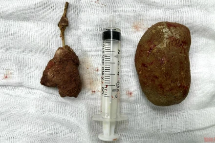 2 viên sỏi to với trọng lượng 300 g được phẫu thuật từ cơ thể bệnh nhân.