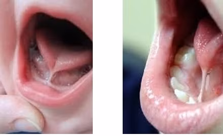 Trẻ mắc dị tật dính lưỡi.