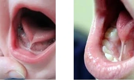Trẻ mắc dị tật dính lưỡi.