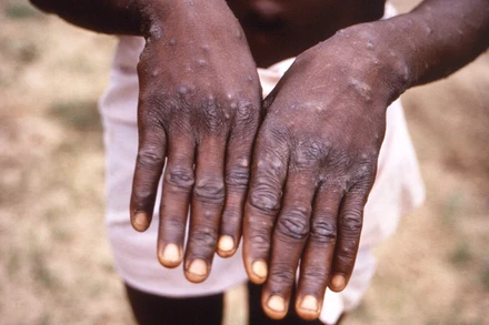 Bệnh nhân mắc đậu mùa khỉ tại Cộng hòa Dân chủ Congo. (Ảnh tư liệu: AFP/TTXVN)