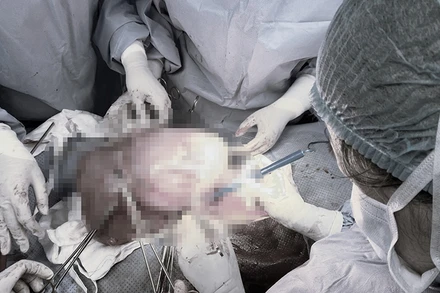 Loại bỏ khối u xơ tử cung nặng 3,2 kg cho người bệnh.