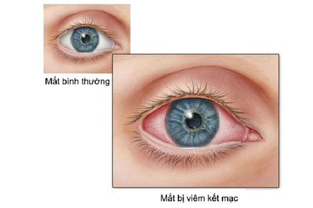 Viêm kết mạc là một trong những biểu hiện của người bệnh dương tính với Covid-19.