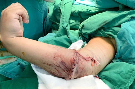 Cẳng tay đứt lìa của bệnh nhi được nối thành công.