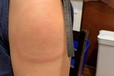 Vết phát ban cánh tay dài 15cm ở người tiêm vaccine Moderna. Đây là triệu chứng vô hại. (Ảnh: Mass General Brigham Hospital)