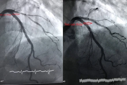 Các bác sĩ tiến hành can thiệp mạch vành cho bệnh nhân.
