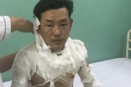 Lê Tấn Tài được can thiệp y tế khi bị bỏng.