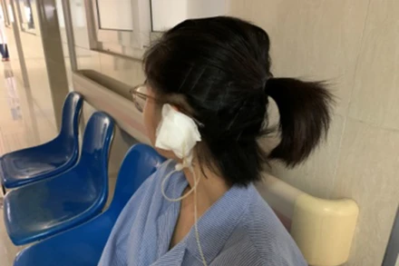 Bệnh nhân bị áp xe vành tai sau khi bấm khuyên vành tai. 