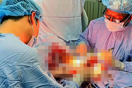 Ê-kíp tiến hành phẫu thuật hơn 5 giờ nối lại bàn tay đứt rời cho bệnh nhân.