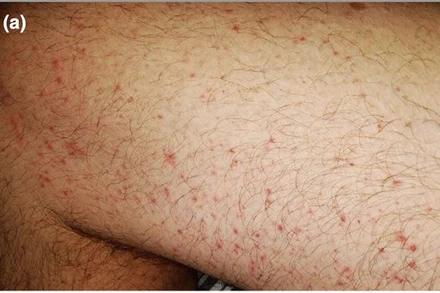 Hình ảnh dát sẩn quanh nang lông. 