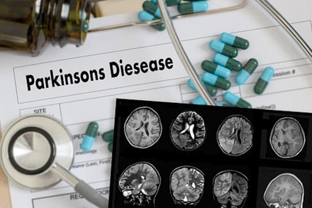 AI có thể giúp theo dõi chính xác từ xa bệnh nhân mắc Parkinson.