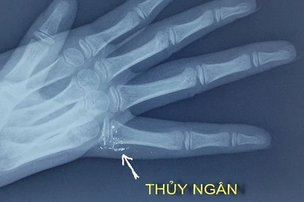 Hy hữu trẻ bị nhiễm độc thủy ngân qua da