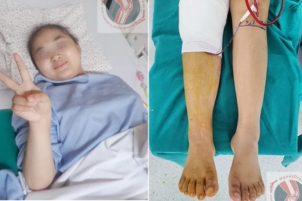 Bệnh nhi đang dần bình phục sức khỏe với đôi bàn chân mới. 