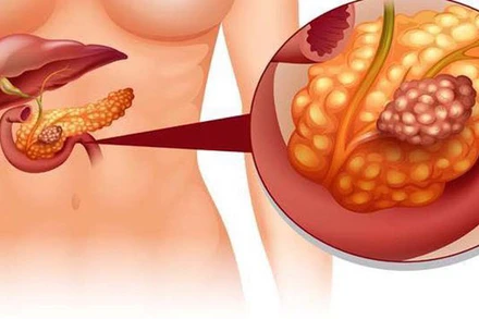 Rượu bia liên miên ba ngày Tết, coi chừng viêm tụy cấp