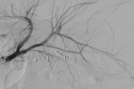 Sau nút mạch quanh động mạch trực tràng. (Ảnh: BVCC)