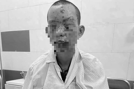 Bệnh nhân bị tổn thương mất thị lực.