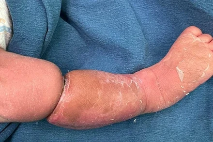 Vòng thắt bẩm sinh ở bé trai.