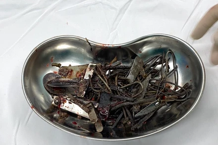 Dị vật trong người bệnh nhân được các bác sĩ lấy ra (ảnh bệnh viện cung cấp)