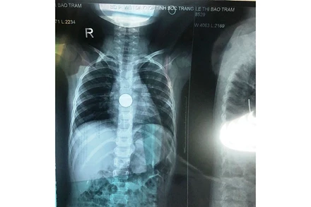 Hình ảnh dị vật đồng xu khi bé T mới nhập viện.