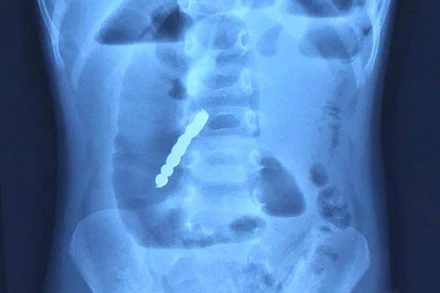 Hình ảnh chụp X-quang phát hiện bảy viên bi nam châm gây thủng ruột bệnh nhi.