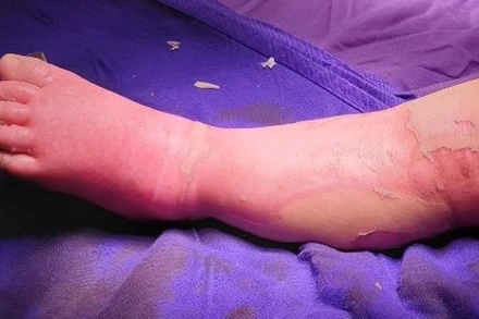 Biến chứng do đắp lá chữa bỏng nước sôi cho trẻ